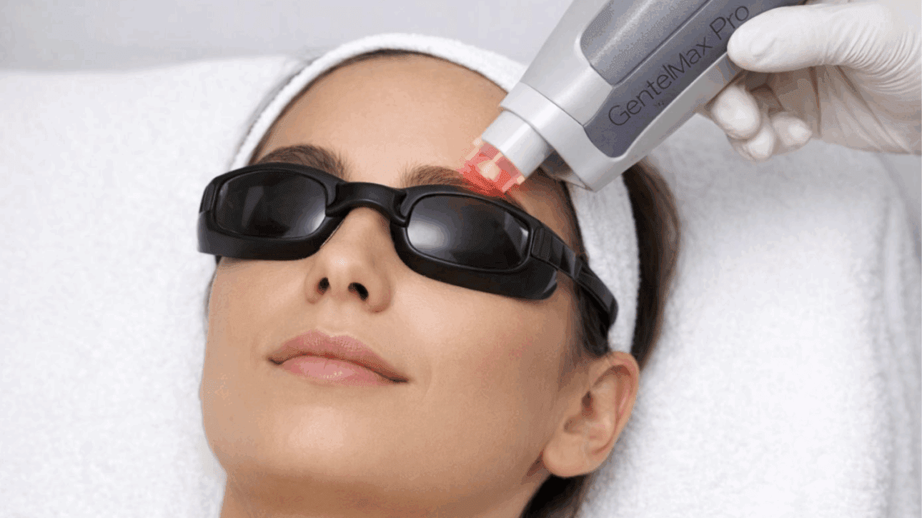 Épilation Laser Sourcil : Fonctionnement, Procédure, Coût et Résultats Expliqués (Guide 2026)