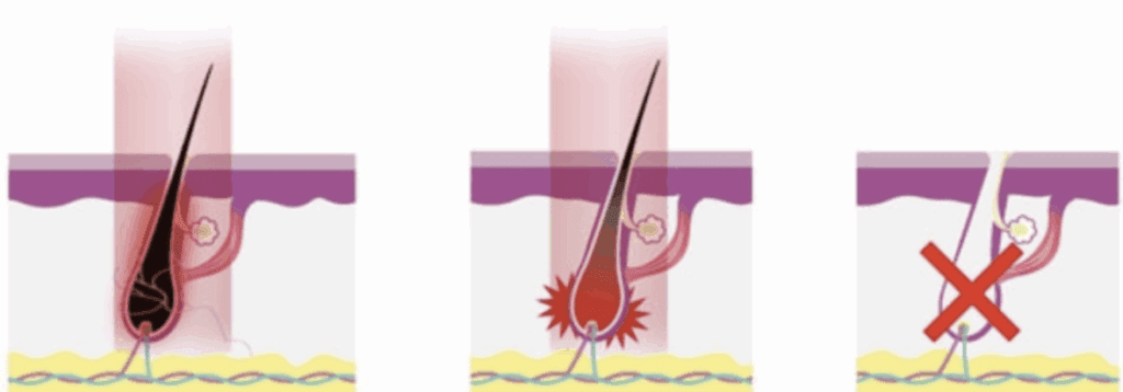 Schéma du principe de l’épilation laser : le poil absorbe l’énergie puis le follicule est progressivement altéré