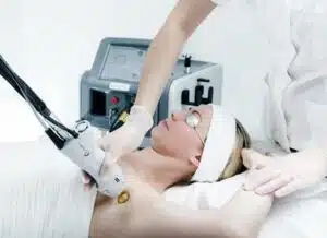 laser hair removal