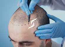 Greffe capillaire en cours