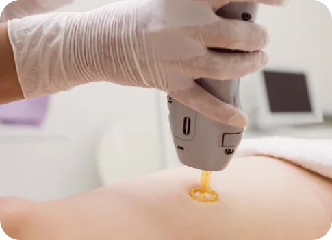 Main gantée utilisant une pièce à main laser Alexandrite/Nd:YAG sur la peau lors d’une séance d’épilation en cabinet médical | NY Center