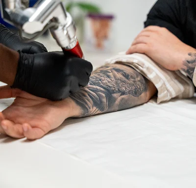 Détatouage au laser sur l’avant-bras | NY Center