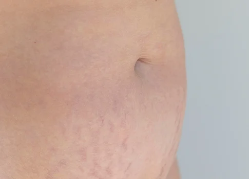 Vergetures abdominales – contre-indications avant épilation laser | NY Center