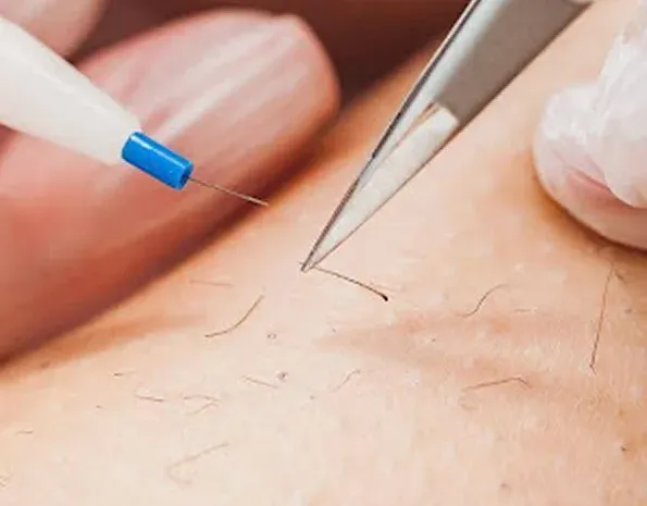 Procédure épilation électrique