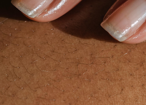Gros plan de peau avec duvet fin et poils clairsemés, illustrant les zones à éviter lors d’une épilation laser | NY Center