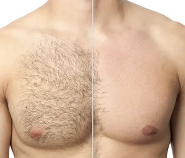 Comparaison avant et après épilation laser sur le torse