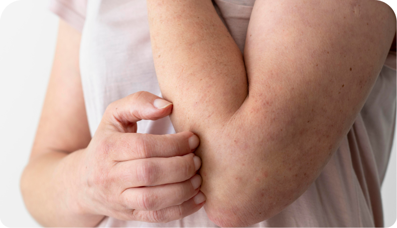 Érythème et œdème discret après tir | NY Center