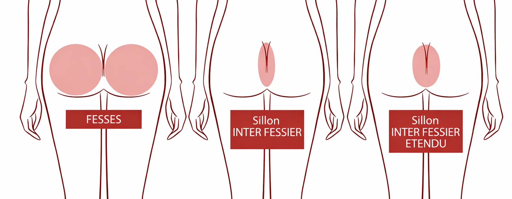 Zones d’épilation laser : fesses et sillon inter-fessier | NY Center