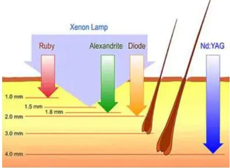 Schéma comparatif montrant la profondeur de pénétration des lasers Ruby, Alexandrite, Diode et Nd:YAG dans la peau et le follicule pileux | NY Center