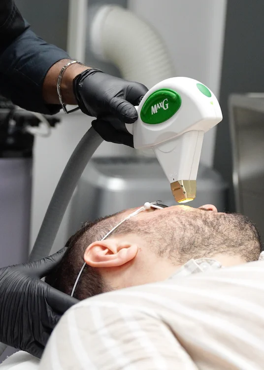 traitement taches brunes du visage avec IPL