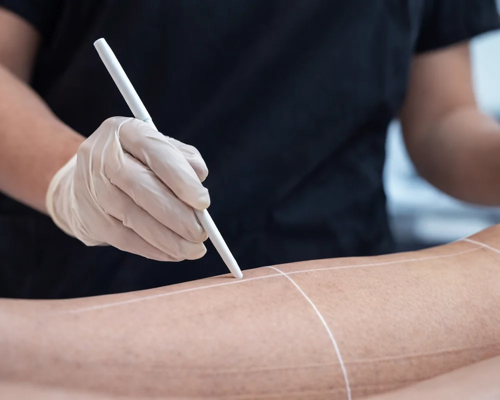 Épilation définitive au laser des jambes | NY Center