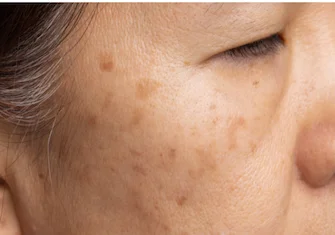 Hyperpigmentation post inflammatoire