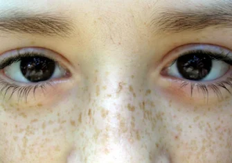 Taches de rousseur / éphélides