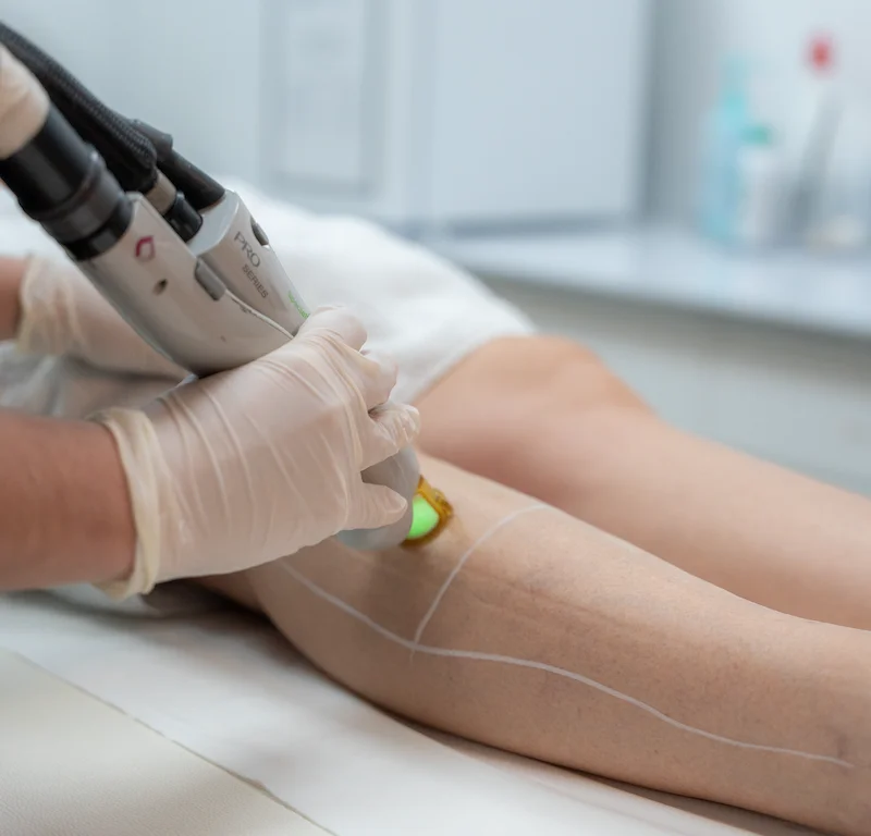 Épilation laser définitive des jambes | NY Center