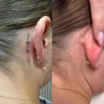 Détatouage laser à Évreux