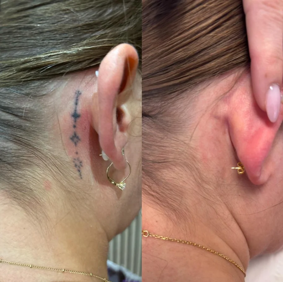 Détatouage laser Évreux