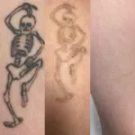 Comparaison avant et après détatouage d’un tatouage