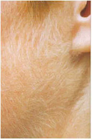 Pilosité excessive (hypertrichose) localisée avant évaluation médicale pour prise en charge laser