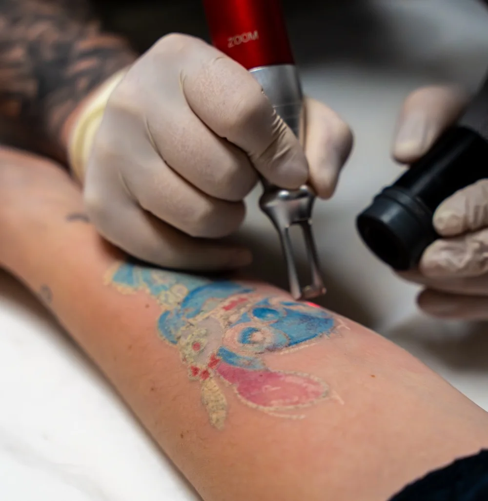 Détatouage laser Elbeuf