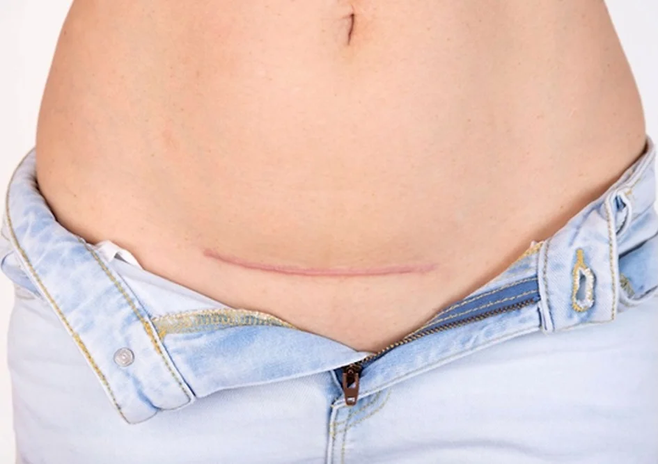 Cicatrice de césarienne sur le bas-ventre féminin