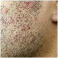 Poil incarné (poil sous peau) avec inflammation folliculaire superficielle