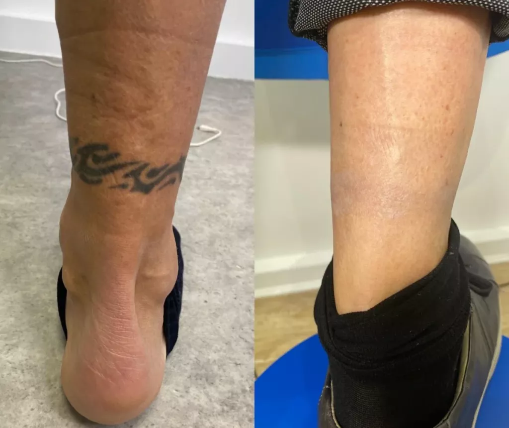 Tatouage sur la cheville avant traitement