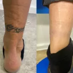 Tatouage sur la cheville montrant l’évolution du traitement