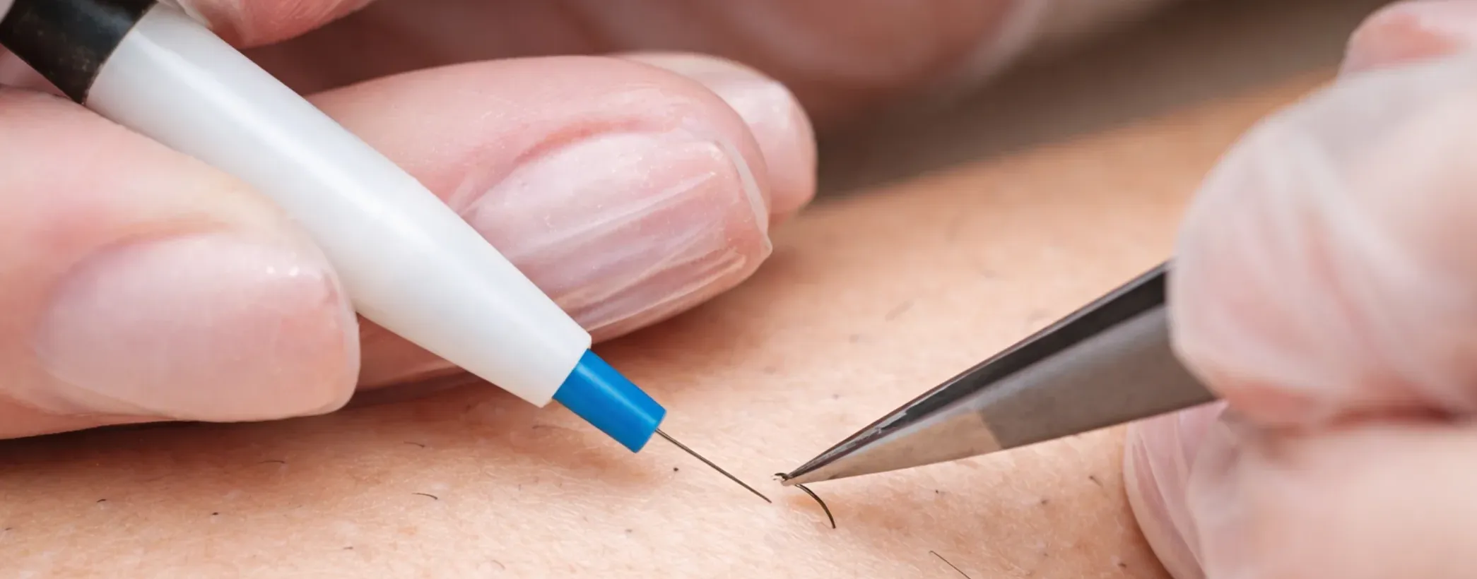 Électrolyse ciblée pour poils fins | NY Center