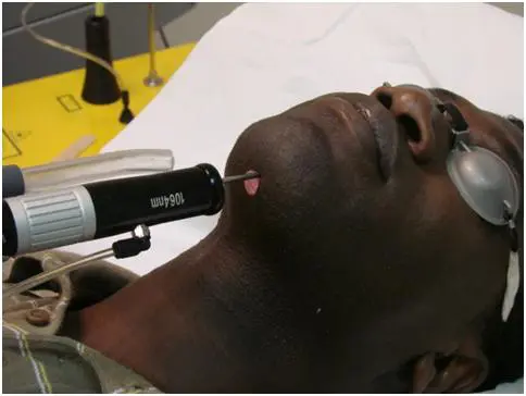 poils incarnés chez phototype foncé