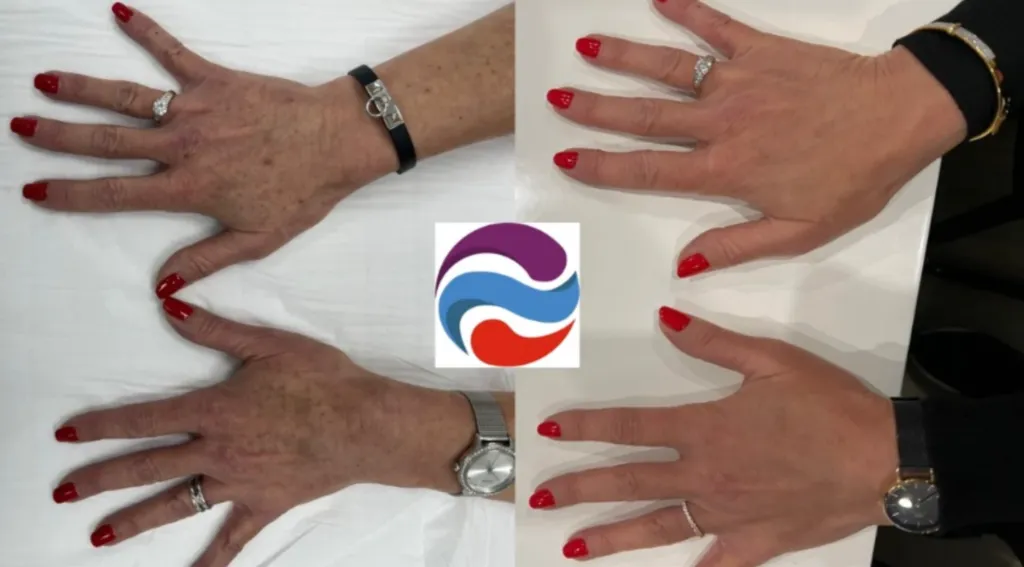 avant après traitement taches brunes des mains