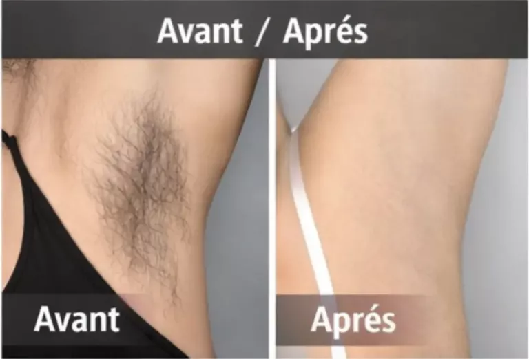 Comparaison avant après de réduction de pilosité après épilation laser médicale des aisselles