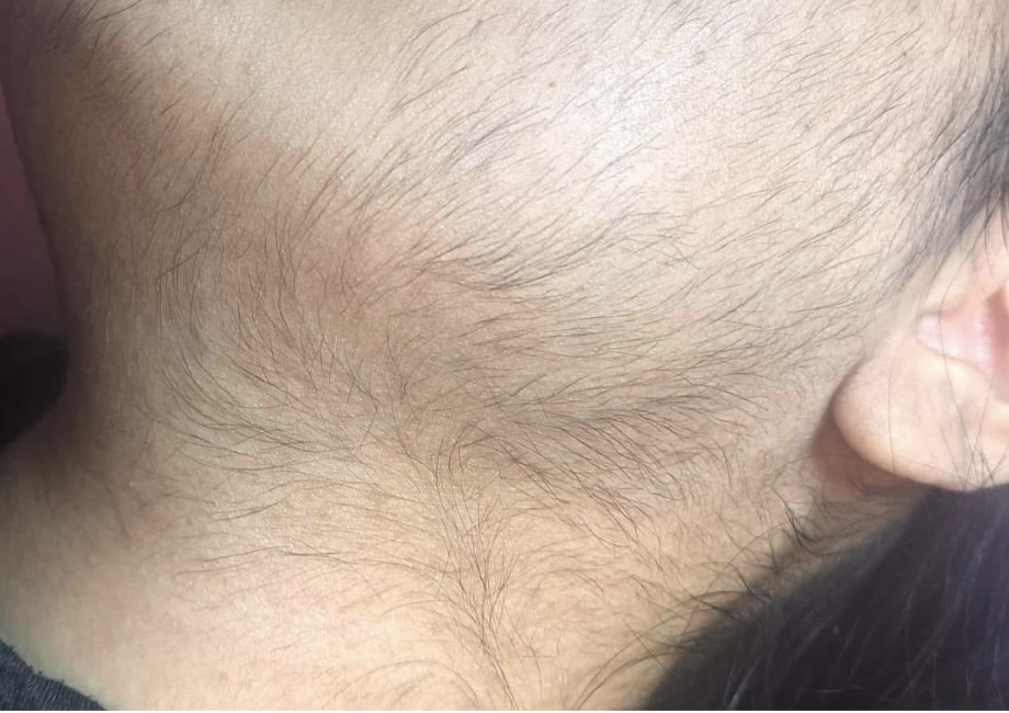 epilation laser rouen 1