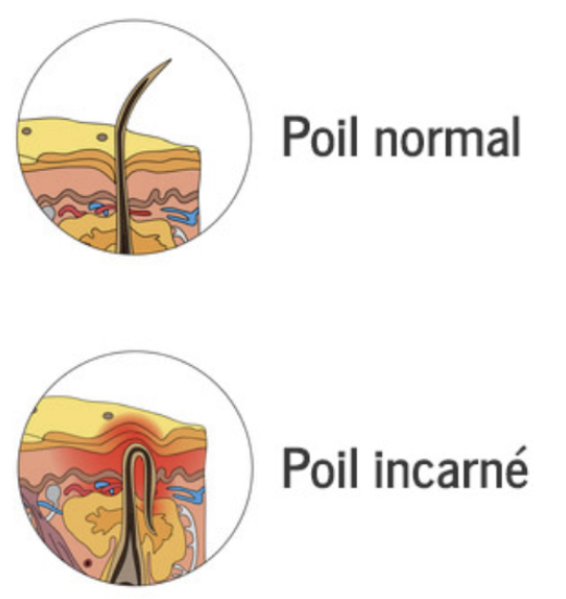 Schéma comparatif entre poil normal et poil incarné sous la peau