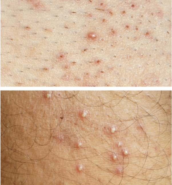 Aspect clinique de poils incarnés et de folliculite après rasage