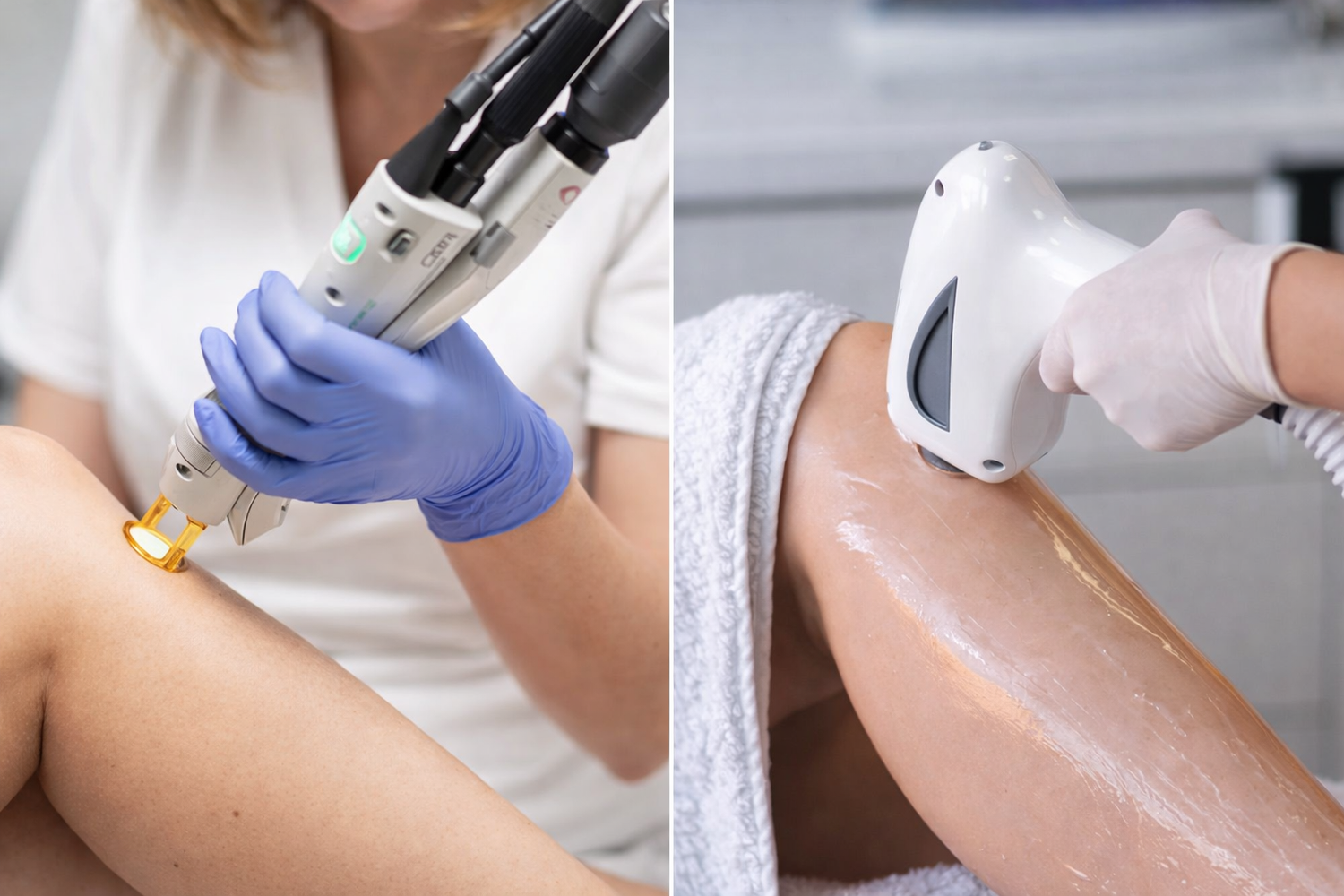 laser vs ipl rouen 1