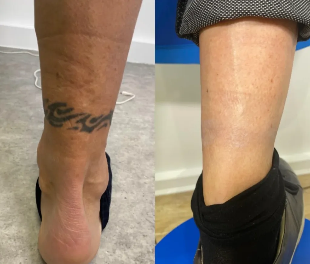resultats detatouage laser 1